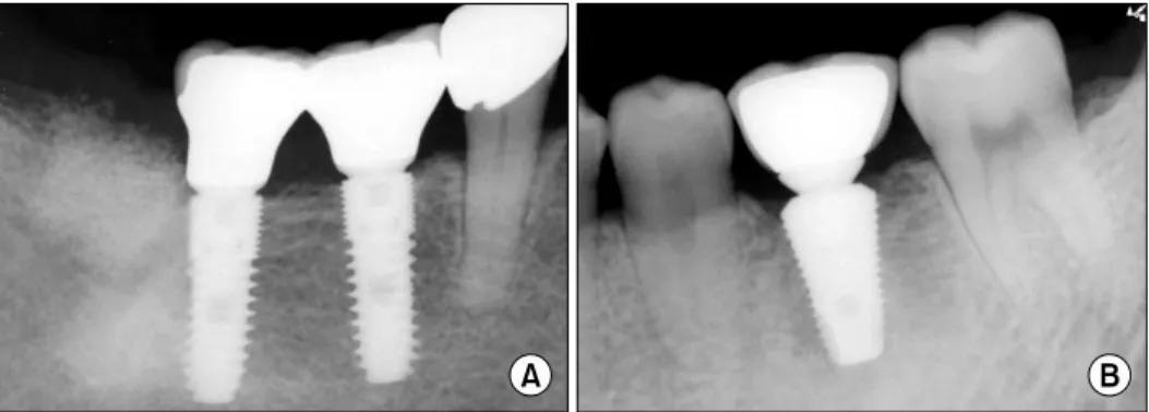 Fig. 1. Periapical views of implants.