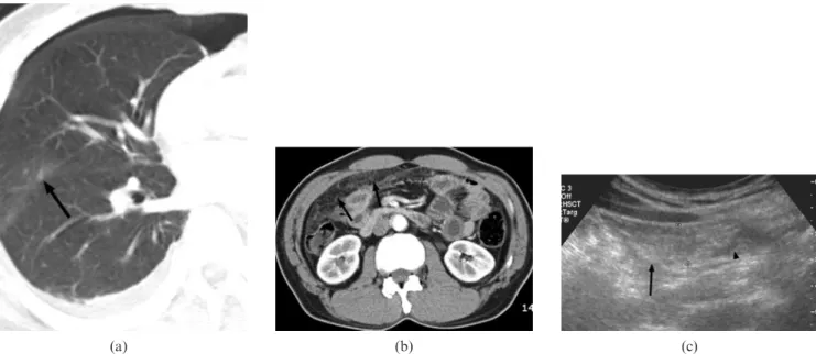 Figure 2. A 50-year-old male with paragonimiasis (Patient 1). An axial chest CT scan (5 mm collimation) ob- ob-tained at the lung setting (a) shows tiny, ill-defined nodules in the fissural area (arrow)