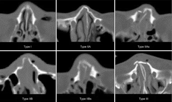 Fig. 1. Classification of nasal bone fracture. Each types classification according to the standard of Hwang et al.’s classification[4].