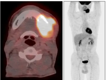 Fig. 2. Preoperative computed to- to-mography images revealed 4 cm  heterogenous mass in left mandible invading adjacent soft tissues.