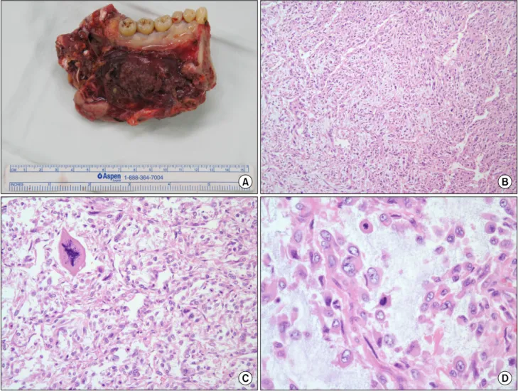 Fig. 4. Postoperative panoramic image shows reconstructed left mandible with fibula free flap