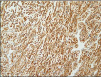 Fig. 6. In immunohistochemical study, only vimentin reactivity  is detected (Vimentin reactivity, ×200).