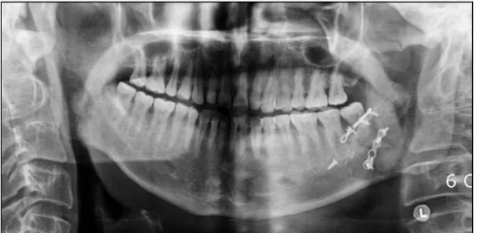 Fig. 2. Presence and extraction of mandibular third molar in  fracture line.