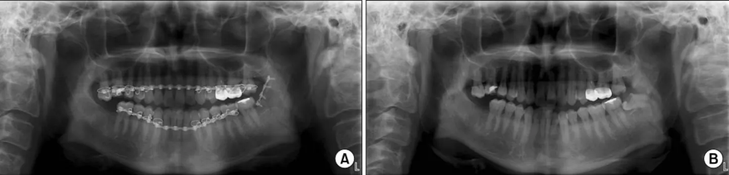Fig. 6. (A) Preoperation. (B) After open reduction internal fixation with miniplate not extracting third molar.