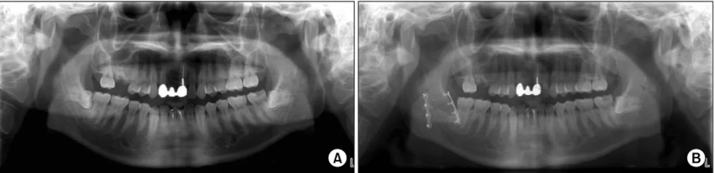 Fig. 7. (A) Preoperation. (B) After open reduction internal fixation with 2 miniplates.