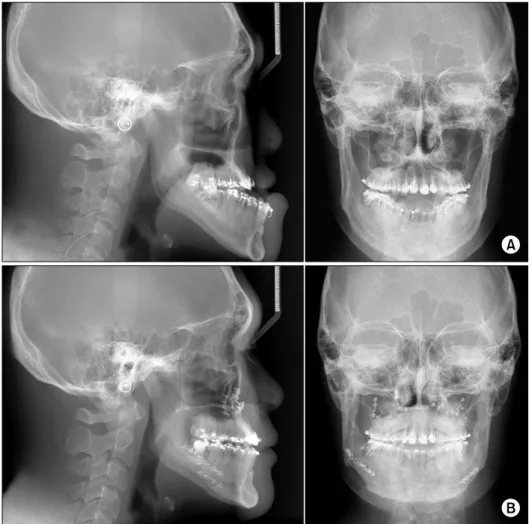 Fig. 1. (A) Preoperative cephalogram. 