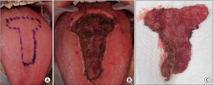 Fig. 2. T-shape tongue reduction method was used as suggested by Harada and Enomoto[2].