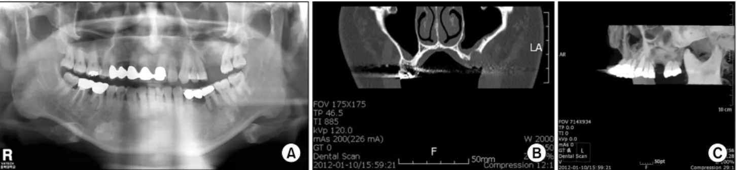 Fig. 1. Diagnosis &amp; radiographic evaluation of the remaining alveolar ridge, maxillary sinus cavity and mandibular ramus