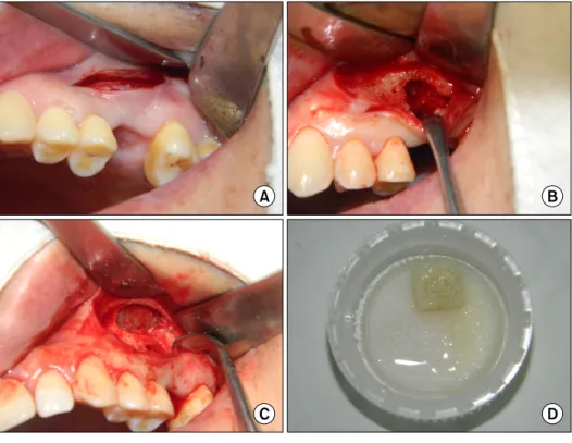 Fig. 3. Vertical alveolar ridge augmentation with the allogenic block bone graft and simultaneous maxillary sinus graft