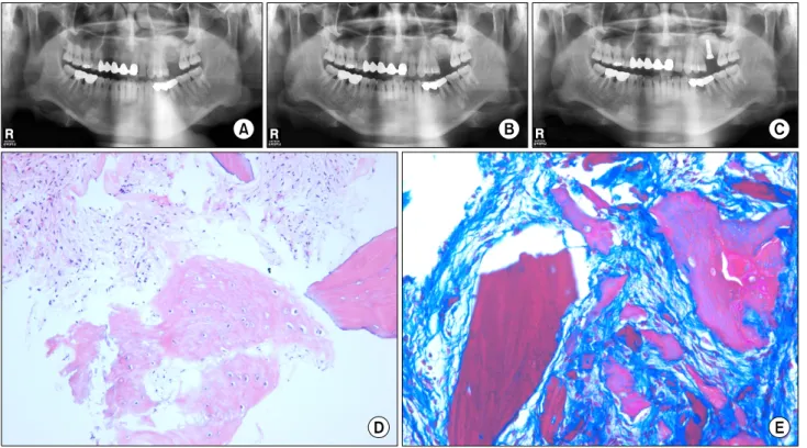 Fig. 4. Dental implant installation on the previous vertical augmentation using allogenic bone graft and sinus graft site