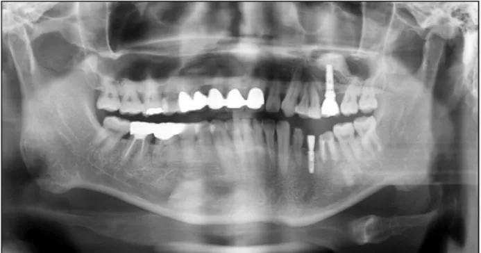 Fig. 5. Twenty months follow-up panoramagraphy after loading (2 years and 6 months after bone graft) of final prosthodontic  treatment shows favorable crown-implant ratio and good healing state of vertical augmentation and sinus graft.