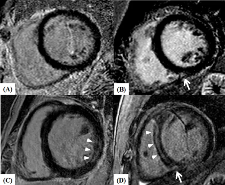 Fig 1. Left ventricle short-axis CMR images of NICM patients showing no LGE (A), patchy LGE confined to the inferior RV insertion area (B, white arrow), midwall LGE at the inferolateral wall of LV (C, arrow heads), and LGE at the midwall of septum (arrow h
