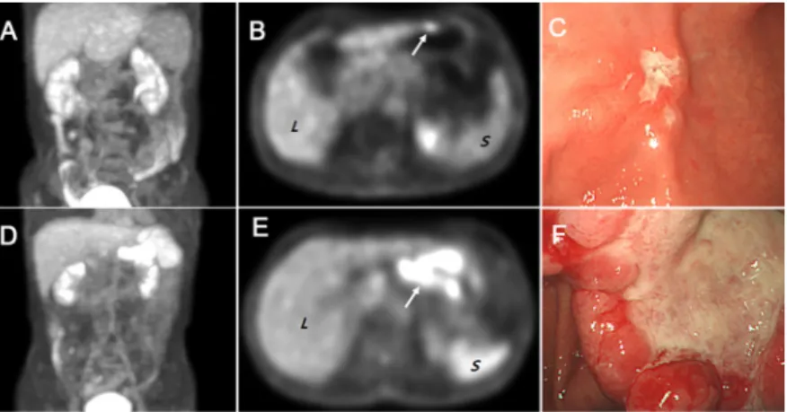 Fig 1. (A-C) A 53-year-old women with stomach cancer underwent FDG PET/CT. The maximum intensity projection (MIP) image (A) and transaxial PET (B) show diffuse spleen ( S) FDG uptake lower than liver (L) FDG