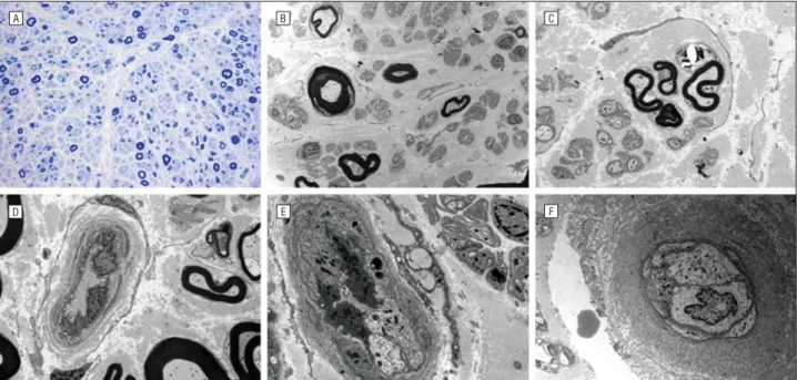 Figure 3. Distal sural nerve biopsies and narrowed endoneural blood vessels. A, Transverse semithin sections of a patient (III-29) with toluidine blue stain revealed the absence of large myelinated fibers, with remaining medium and small fibers and occasio