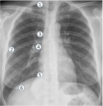 Figure 1. Six locations of phantom nodules: (1) right apex; (2) middle of the right subpleural lung parenchyma; (3) right upper hilum; (4) right lower hilum; (5) right cardiophrenic angle; and (6) right retrohepatic lung parenchyma.
