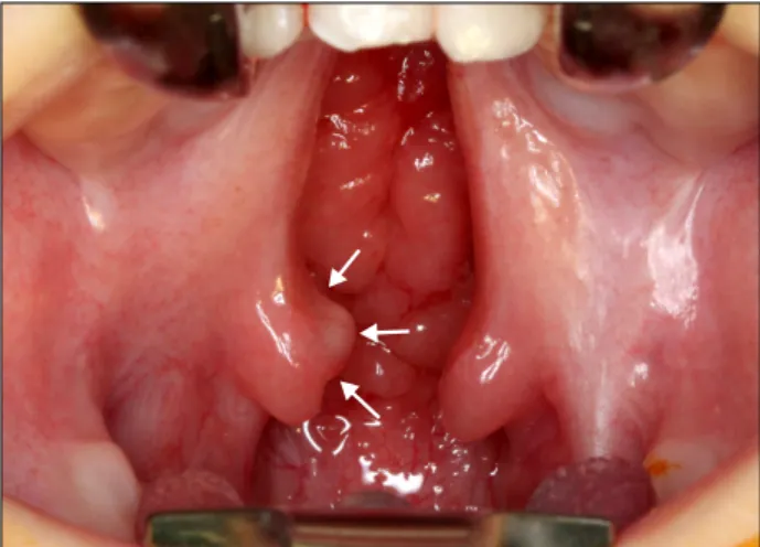 Fig. 2. Specimen. Right side of the uvula shows cystic lesion and  left side is normal deepithelization pattern.
