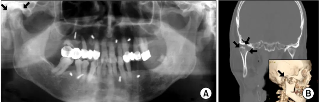 Fig. 8. Localized irregular thickening of trabecular bone (H&amp;E, 