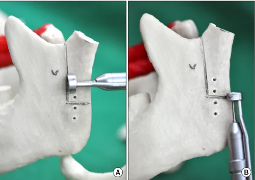 Fig. 2. Drawing of the vertical and horizontal osteotomy lines. 