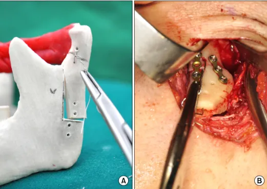 Fig. 5. (A) The mandibular condylar head and osteotomized bony  seg-ment were reduced by wire