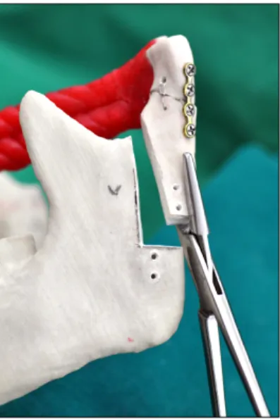 Fig. 6. The reduced condylar head was repositioned to its original position within its fossa.