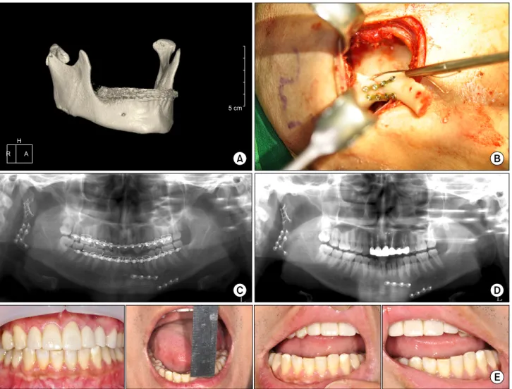 Fig. 8. (A) Preoperative computed tomography shows that the mandibular condylar head was dislocated to the medio-inferior position.
