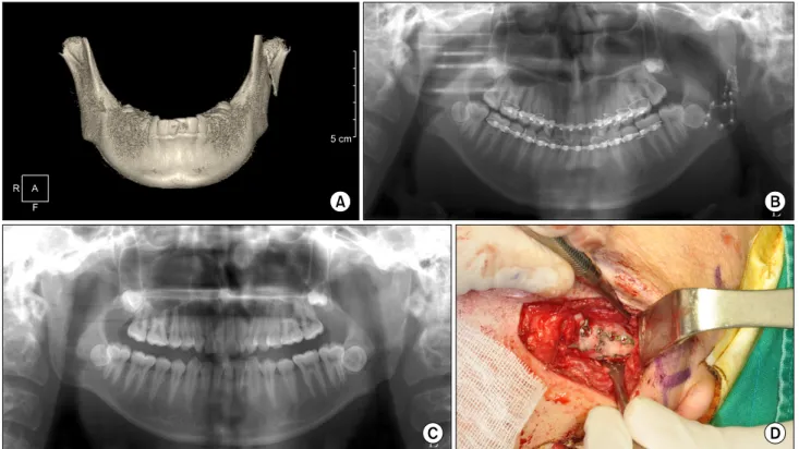 Fig. 9. (A) Preoperative computed tomography shows that the mandibular condylar fragment was displaced with lateral overlap and  there was some loss of vertical ramal height