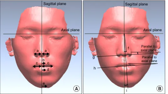 Fig. 4. Linear (A) and angular (B)  variables on the coronal plane. a, alar base width; b, upper lip deviation; 