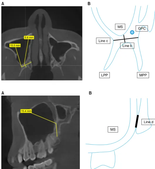 Fig. 3. (A) Line d is the vertically  longest line of pterygoid junction  on the sagittal view, distance d is the distance of line d