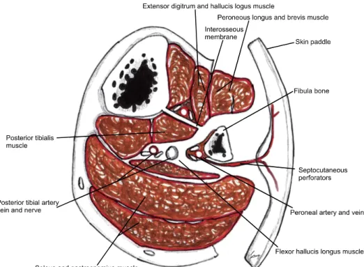 Fig. 2. Schematic cross-sectional  drawing of the fibular composite  flap harvesting procedure.