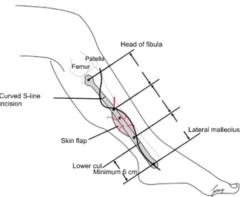 Fig. 6. Preoperative skin marking of the septocutaneous 