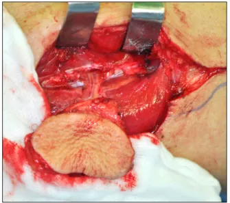 Fig. 8. Contouring fibula according to the prepared resin template similar to the individual patient's rapid prototype model