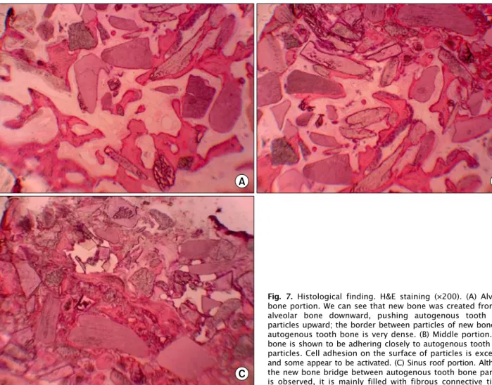 Fig. 7. Histological finding. H&amp;E staining (×200). (A) Alveolar  bone portion. We can see that new bone was created from the  alveolar bone downward, pushing autogenous tooth bone  particles upward; the border between particles of new bone and  autogen