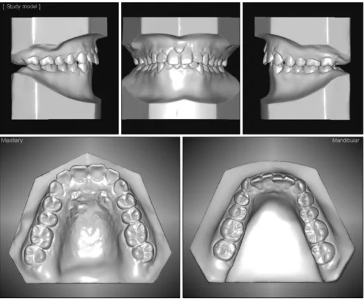 Fig. 2. Pretreatment dental casts.