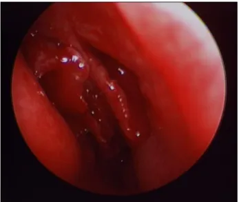 Fig. 1. Computed tomography image showing radiopacification 