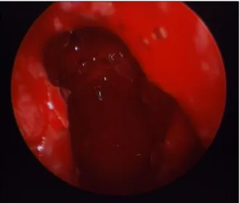 Fig. 5. Computed tomography image showing significantly  reduced radiopacification after the ostium was widened.