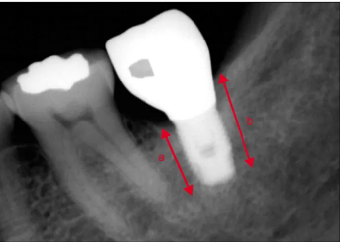 Table 1. Type of surgery using autogenous tooth bone graft  material