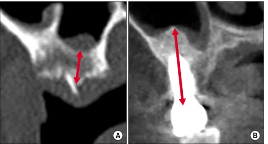 Fig. 3. ISQ evaluation. ISQ, implant stability quotient; POD,  post-operative day; GBR, guided bone regeneration.
