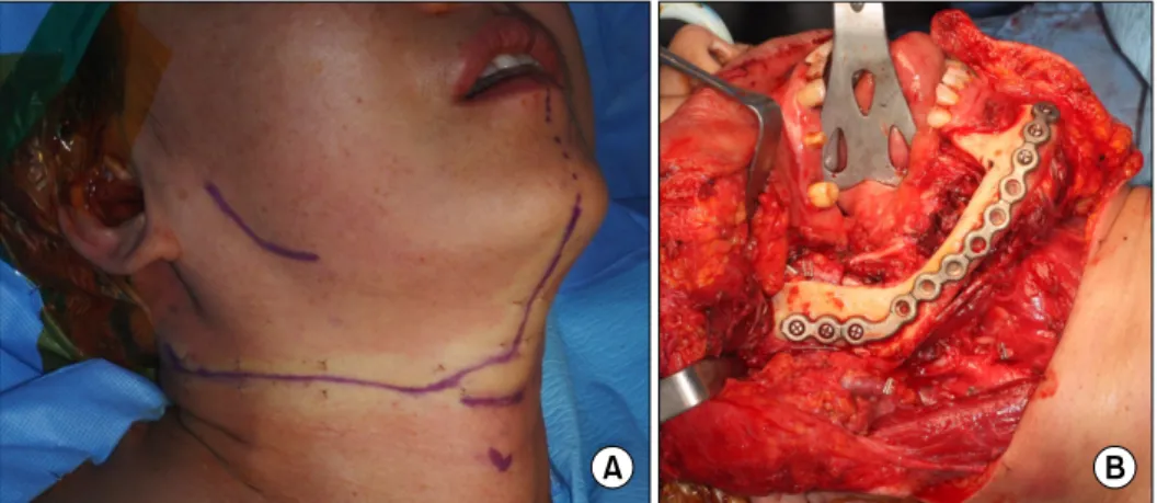 Fig. 2.  (A)  Design  of  surgical  ap- ap-proach for wide excision &amp;  supra-omohyoid neck dissection (SOHND) (right)