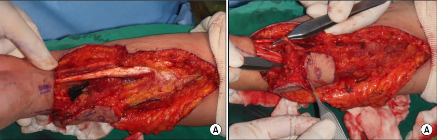 Fig. 3. Design of radial forearm free flap. We planned the radial forearm free flap that the size of skin flap was about 6×7 cm,  and feeding vessels were consisted with radial artery, vena  comitans, and cephalic vein.