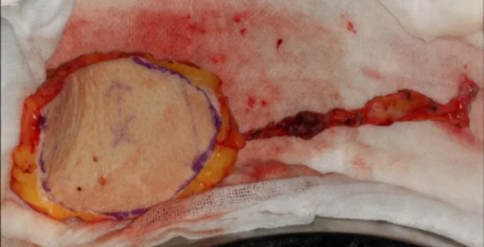 Fig. 7. Intraoperative finding after closure completely with flap adaptation &amp; anastomosis