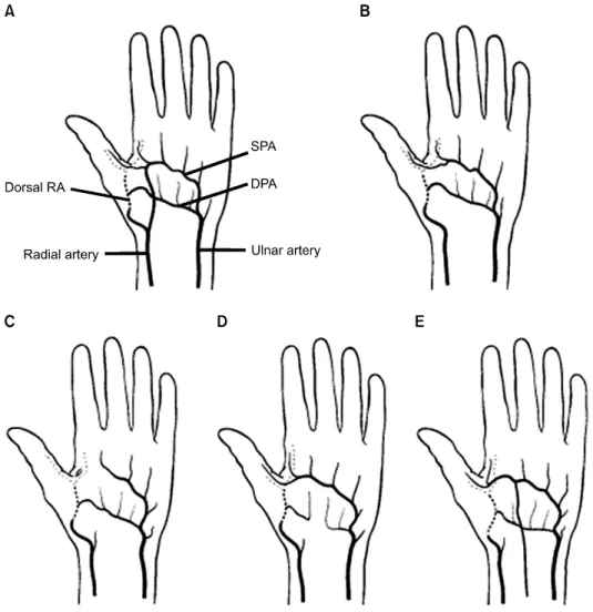 Fig. 10. Variations of the hand col- col-lateral circulation, palmar aspect of the left hand (A∼E)