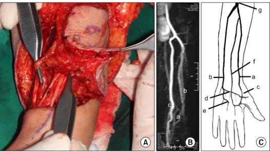 Fig. 11. (A) Arterial branch detected additionally on an interspace between the radial artery &amp; ulnar artery during elevation of radial  forearm free flap