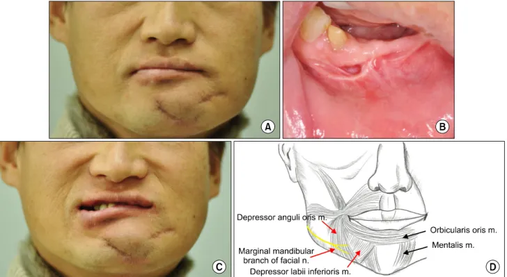 Fig. 1. (A) Prominent scar on the mandibular symphysis and the left end of lower lip area were observed with lower lip asymmetry.