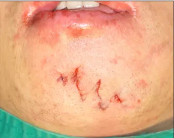 Fig. 3. (A) Injection botulium toxin type A (BTX-A) on right lower lip  de-pressors at 6 weeks postoperatively.