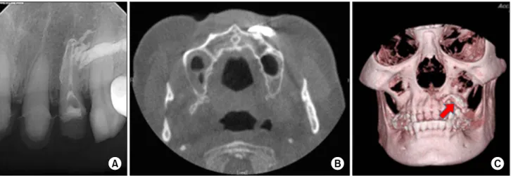 Fig. 1. Preoperative radiographic image: (A) periapical view: the spread of the endodontic paste (Vitapex; Neo Dental Chemical Products Co., Tokyo, Japan) beyond the apex of the right lateral incisor is evident in periapical radiograph
