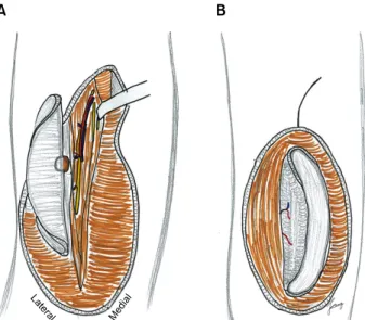 Fig. 11. Schematic drawings of cutaneous anterolateral thigh  (ALT) flap by keeping the small patch of fascia, (A) cutaneous  perforator identification from the septum or muscle substance,  and (B) suprafascial elevation of lateral portion showing the fasc