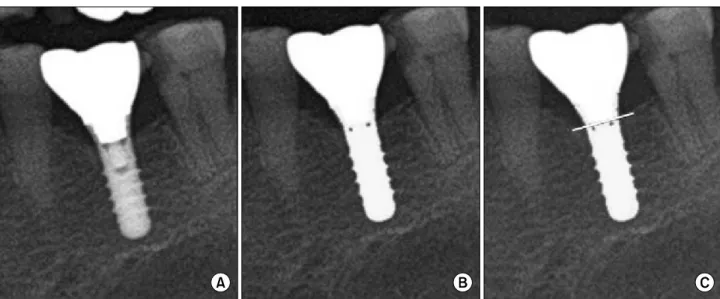 Fig. 2. Recognition of implant fixture with marginal bone according to implemented segmentation systems used in this study, before (A), after application (B), and determination point (C).