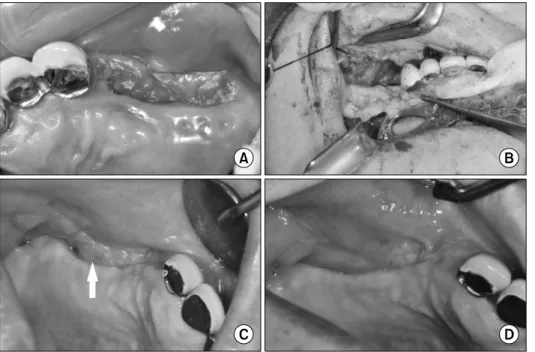 Fig. 1. (A) The preoperative status  showed the necrotic bone on the  in-fected site. (B) The application of  pedi-cled buccal fat pad flap to defect