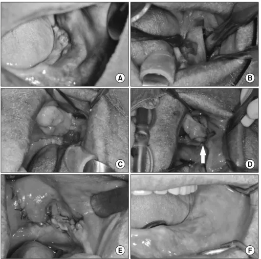 Fig. 2. (A) The preoperative status showed the granulation tissue on  the infected site