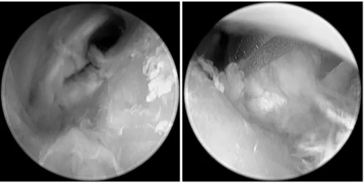 Fig. 1. Hard to define the osteochondroma and meniscus.